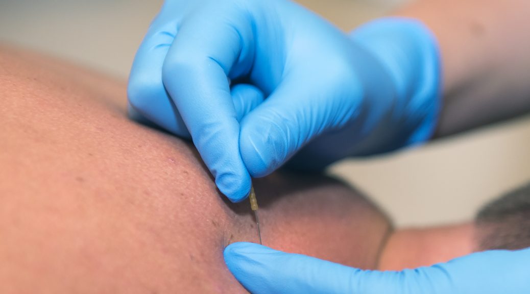 dry needling - what to expect